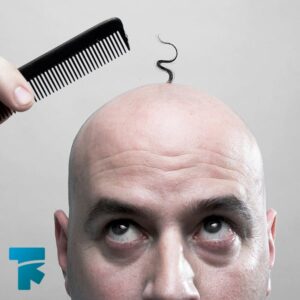 دلایل ریزش مو، الگوی طاسی در مردان