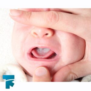نشانه های برفک دهان در نوزادان