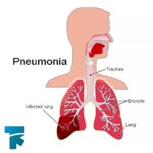 علائم عفونت ریه یا پنومونی یا ذات الریه