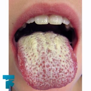 عوامل تاثیرگذار در بروز برفک دهان