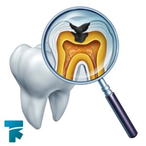 عصب کشی دندان، عوامل آسیب زننده به پالپ دندان