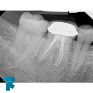 نکات بعد از عصب کشی دندان، گرفتن عکس اشعه ایکس از دندان