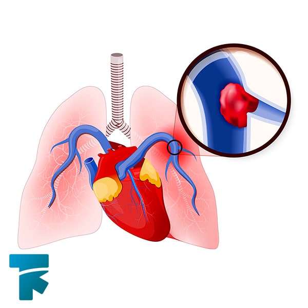 بیماری آمبولی ریه چیست؟