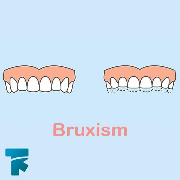 دندان قروچه یا بروکسیسم چیست؟