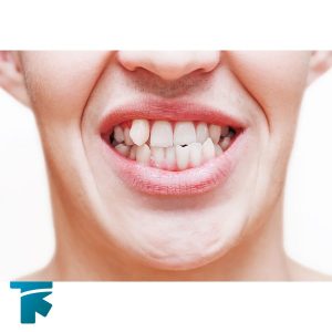 دلایل ایجاد دندان قروچه یا بروکسیسم